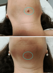 plasmage PO CLINIC VALENCIA